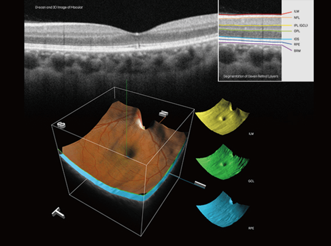 OCT (Optical Coherence Tomography) 