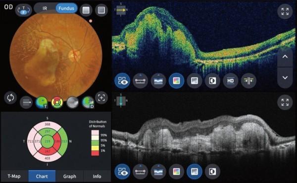 OCT (Optical Coherence Tomography) 